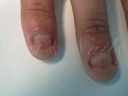 1a Middel- en ringvinger na 8 weken