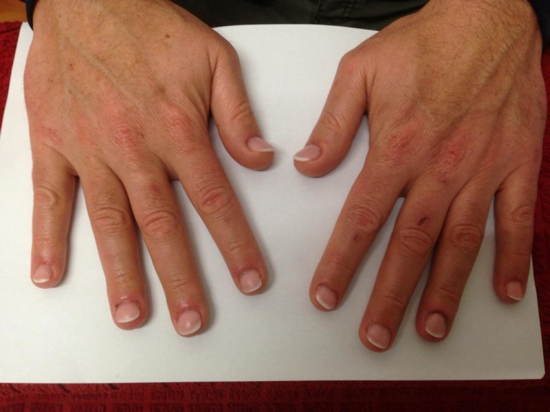 1B Mannelijke nagelbijter na de behandeling.jpg