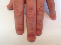 2A Mannelijke nagelbijter voor de behandeling EV