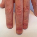 2A Mannelijke nagelbijter voor de behandeling EV.jpg