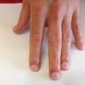 2B Mannelijke nagelbijter na de behandling met cover gel EV.jpg