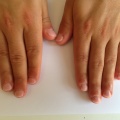 3B Mannelijke nagelbijter na de behandeling RV.JPG