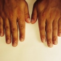 3C Mannelijke nagelbijter na 6 weken (1 arrangement).jpg