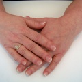 4b Minder extreme nagelbijter na de behandeling IV
