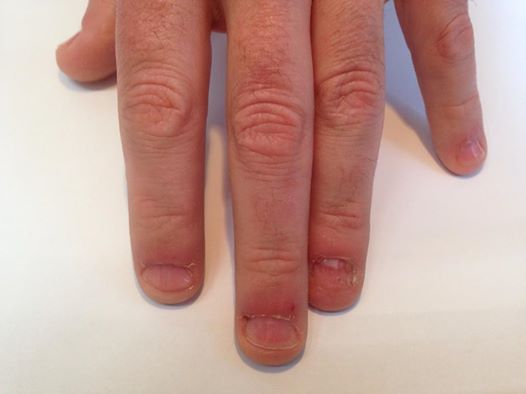 2A Mannelijke nagelbijter voor de behandeling EV