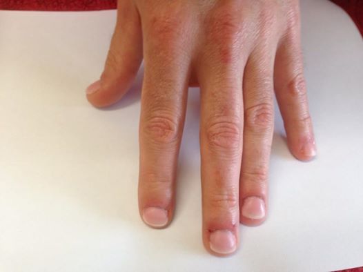 2B Mannelijke nagelbijter na de behandling met cover gel EV.jpg